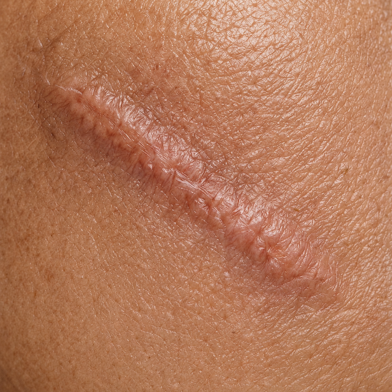 Scar Repair